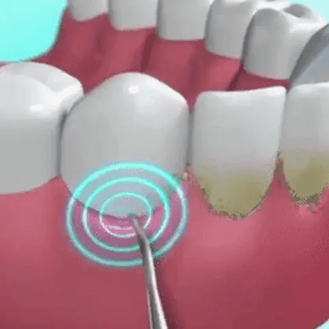 Cepillo Quita Sarro Dental Sonic Pro 3 en 1